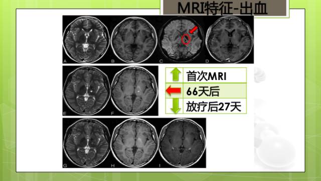 【病例】右侧基底节区生殖细胞瘤1例CT及MR影像表现