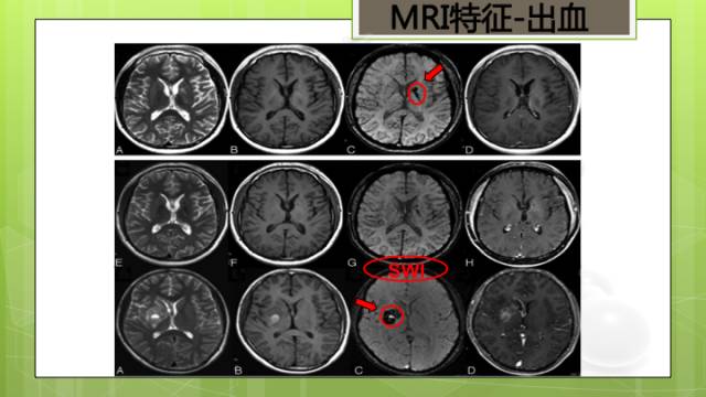【病例】右侧基底节区生殖细胞瘤1例CT及MR影像表现