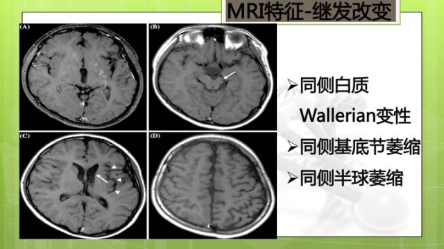 【病例】右侧基底节区生殖细胞瘤1例CT及MR影像表现