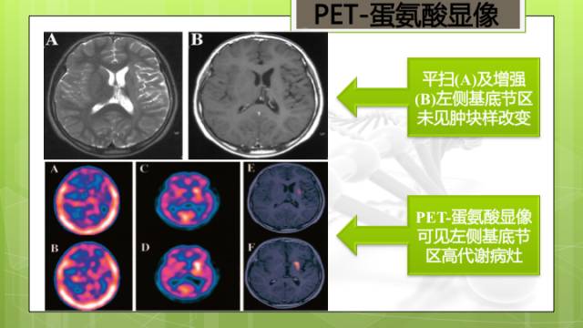 【病例】右侧基底节区生殖细胞瘤1例CT及MR影像表现
