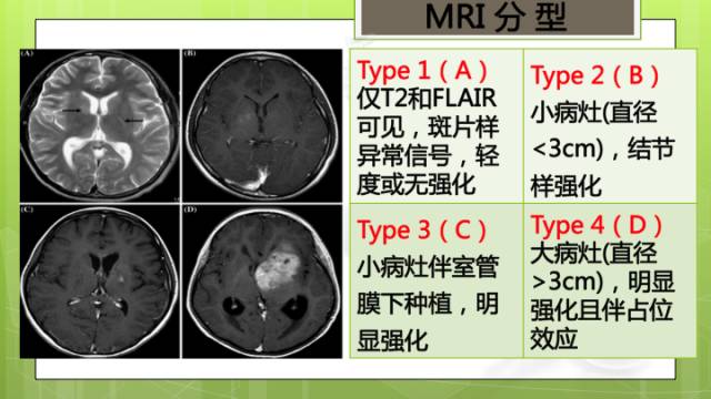 【病例】右侧基底节区生殖细胞瘤1例CT及MR影像表现
