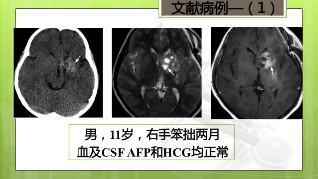 【病例】右侧基底节区生殖细胞瘤1例CT及MR影像表现
