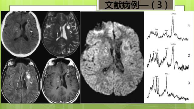 【病例】右侧基底节区生殖细胞瘤1例CT及MR影像表现