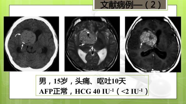 【病例】右侧基底节区生殖细胞瘤1例CT及MR影像表现