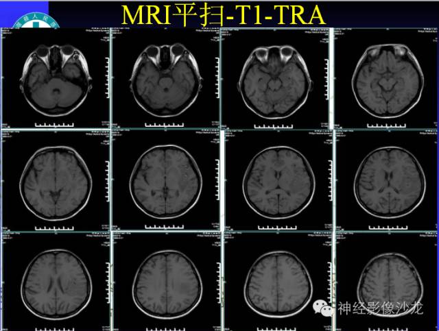【病例】结核性脑膜炎1例MR影像表现