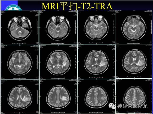 【病例】结核性脑膜炎1例MR影像表现
