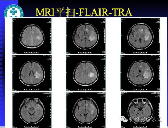 【病例】结核性脑膜炎1例MR影像表现