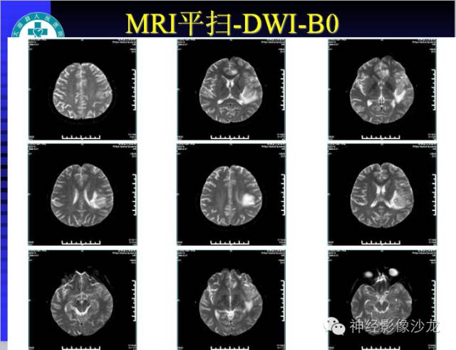 【病例】结核性脑膜炎1例MR影像表现