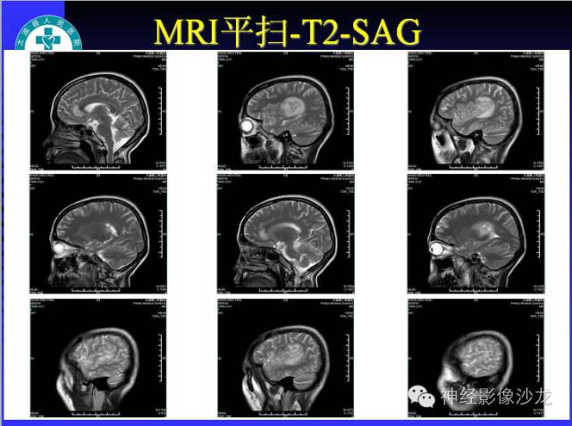 【病例】结核性脑膜炎1例MR影像表现