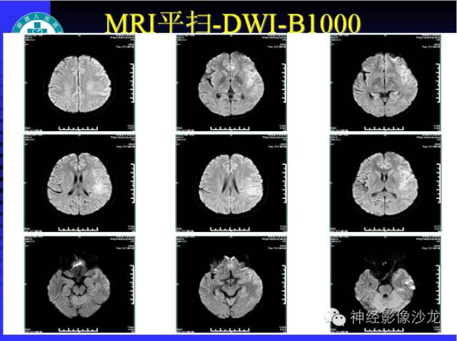 【病例】结核性脑膜炎1例MR影像表现