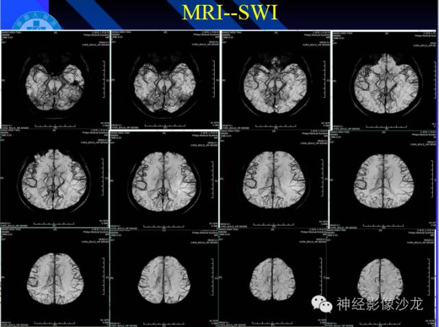 【病例】结核性脑膜炎1例MR影像表现