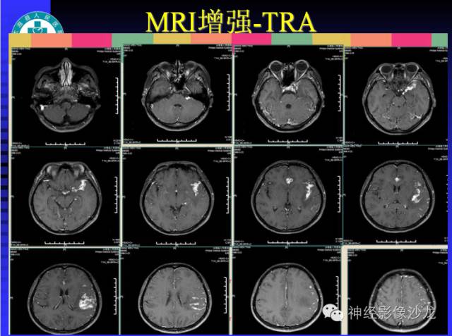 【病例】结核性脑膜炎1例MR影像表现