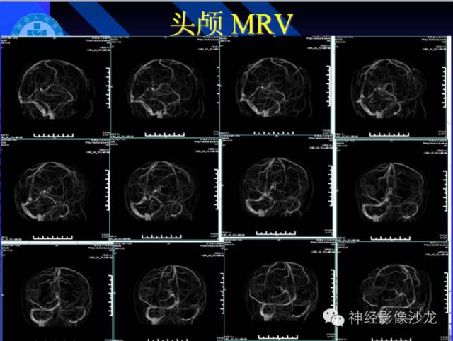 【病例】结核性脑膜炎1例MR影像表现