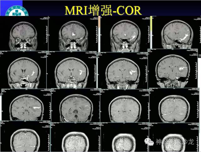 【病例】结核性脑膜炎1例MR影像表现