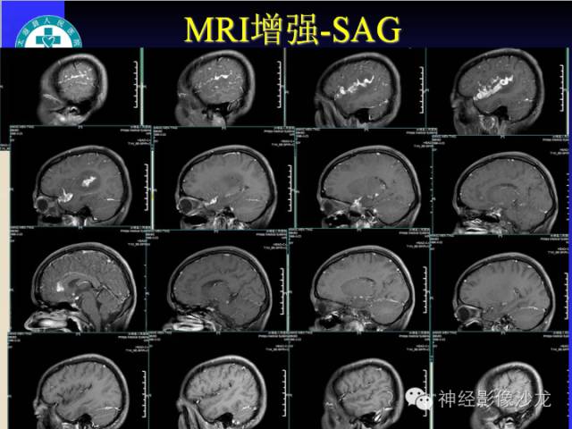 【病例】结核性脑膜炎1例MR影像表现