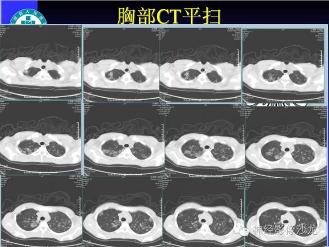 【病例】结核性脑膜炎1例MR影像表现