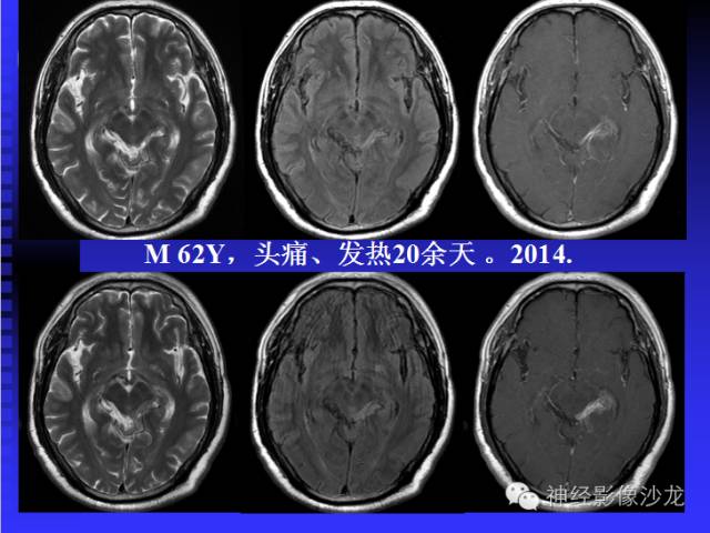 【病例】结核性脑膜炎1例MR影像表现