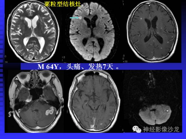 【病例】结核性脑膜炎1例MR影像表现