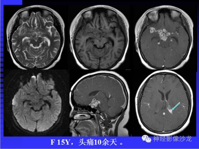 【病例】结核性脑膜炎1例MR影像表现