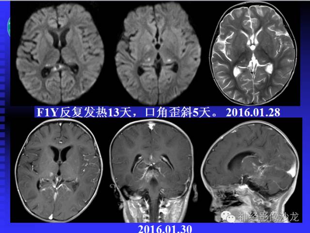 【病例】结核性脑膜炎1例MR影像表现