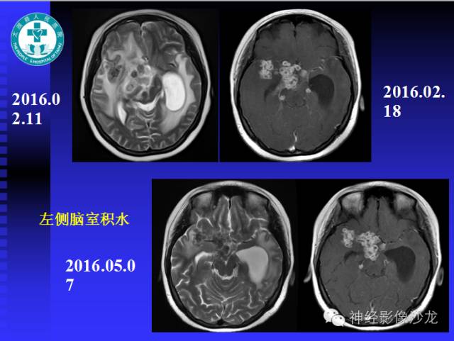 【病例】结核性脑膜炎1例MR影像表现