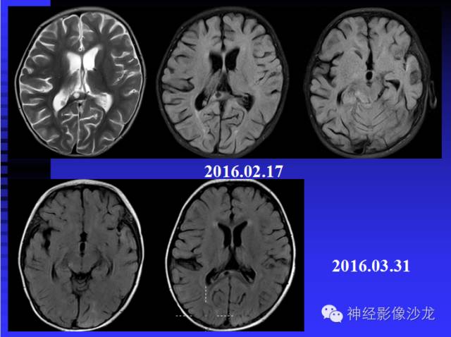 【病例】结核性脑膜炎1例MR影像表现