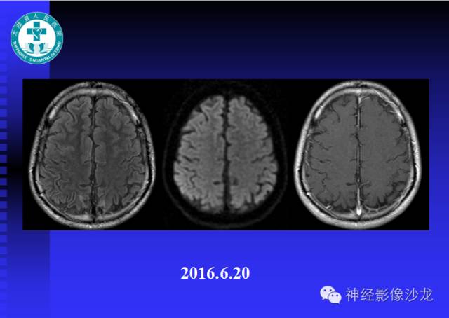 【病例】结核性脑膜炎1例MR影像表现