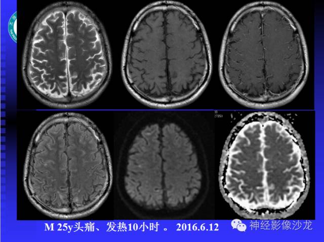 【病例】结核性脑膜炎1例MR影像表现