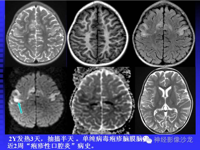 【病例】结核性脑膜炎1例MR影像表现