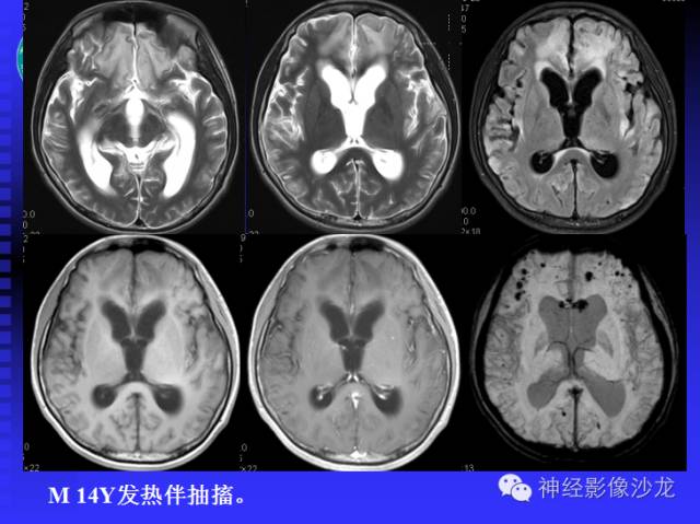 【病例】结核性脑膜炎1例MR影像表现