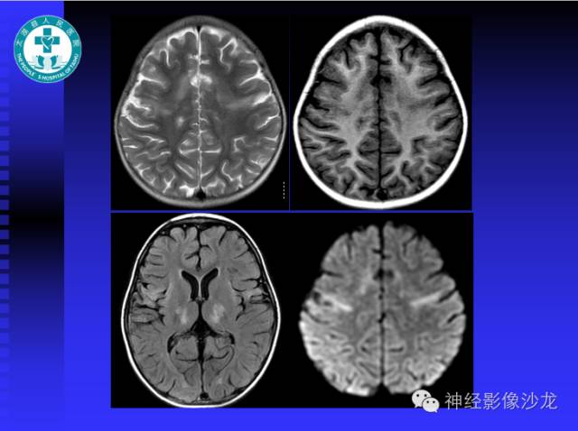 【病例】结核性脑膜炎1例MR影像表现