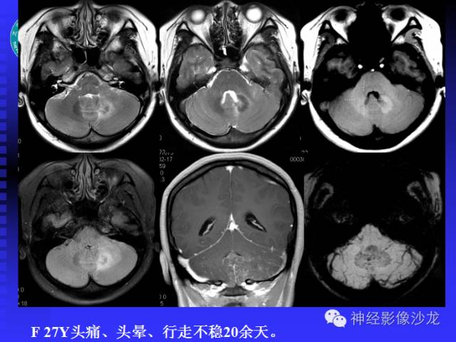 【病例】结核性脑膜炎1例MR影像表现