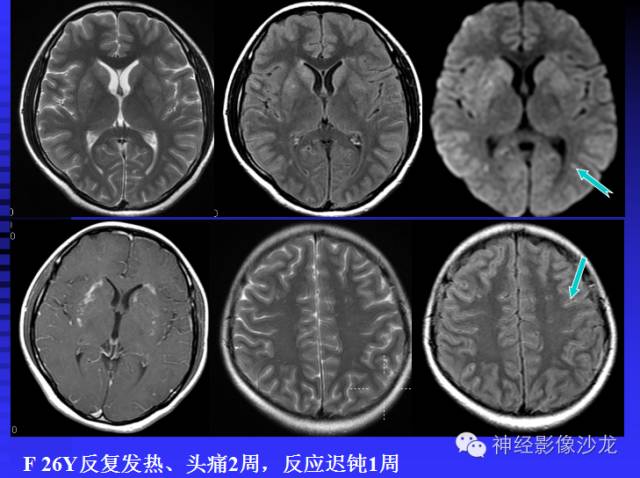 【病例】结核性脑膜炎1例MR影像表现