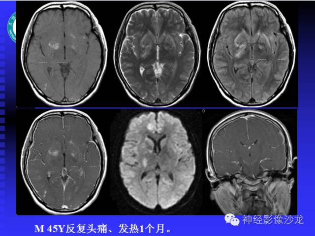 【病例】结核性脑膜炎1例MR影像表现