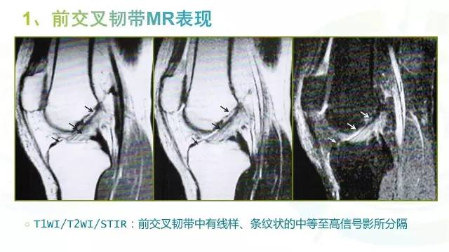 【PPT】膝关节周围韧带解剖及MR表现