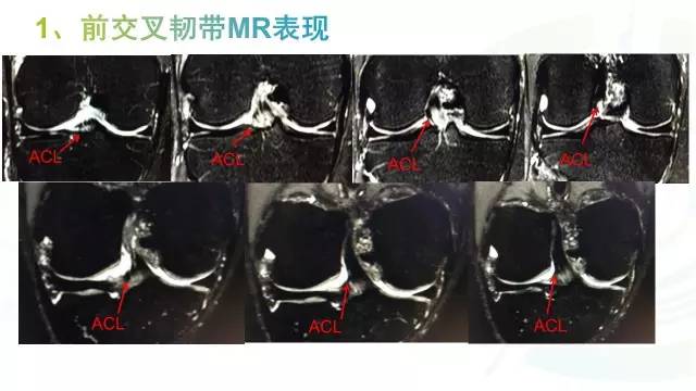 【PPT】膝关节周围韧带解剖及MR表现