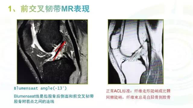 【PPT】膝关节周围韧带解剖及MR表现