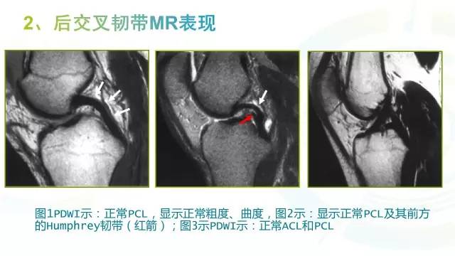 【PPT】膝关节周围韧带解剖及MR表现