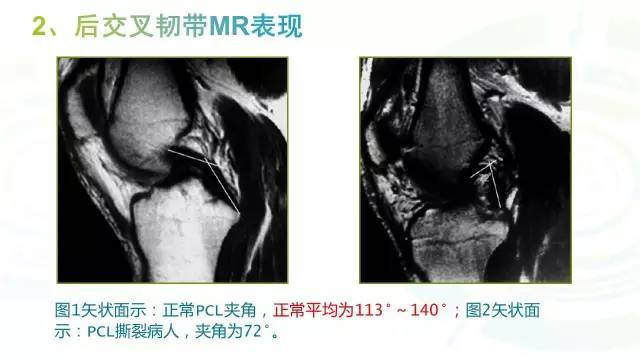 【PPT】膝关节周围韧带解剖及MR表现