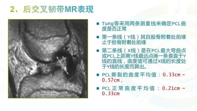 【PPT】膝关节周围韧带解剖及MR表现