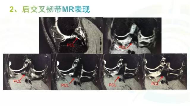 【PPT】膝关节周围韧带解剖及MR表现
