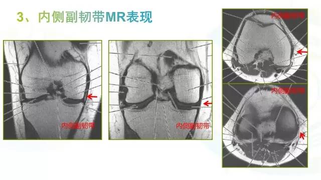 【PPT】膝关节周围韧带解剖及MR表现