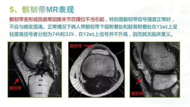 【PPT】膝关节周围韧带解剖及MR表现
