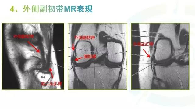 【PPT】膝关节周围韧带解剖及MR表现