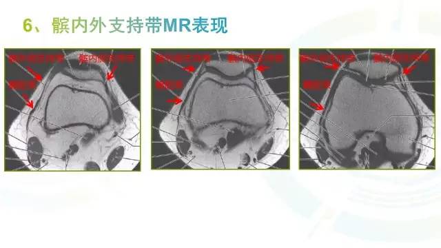 【PPT】膝关节周围韧带解剖及MR表现