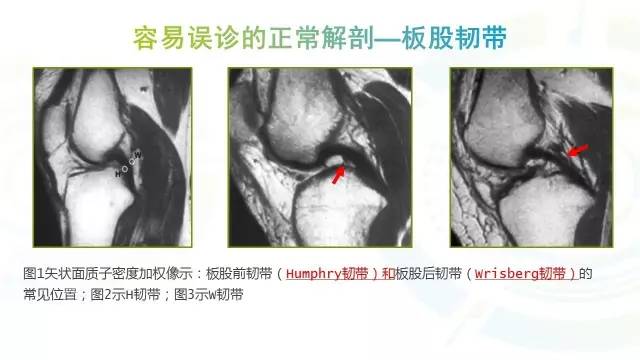 【PPT】膝关节周围韧带解剖及MR表现