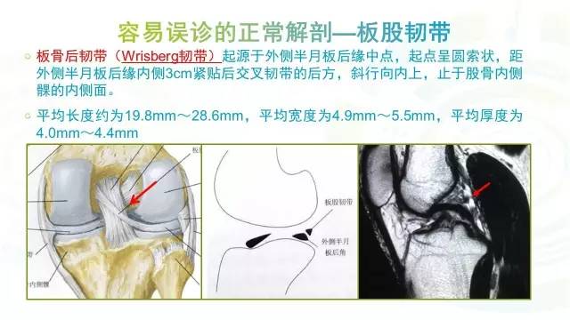 【PPT】膝关节周围韧带解剖及MR表现