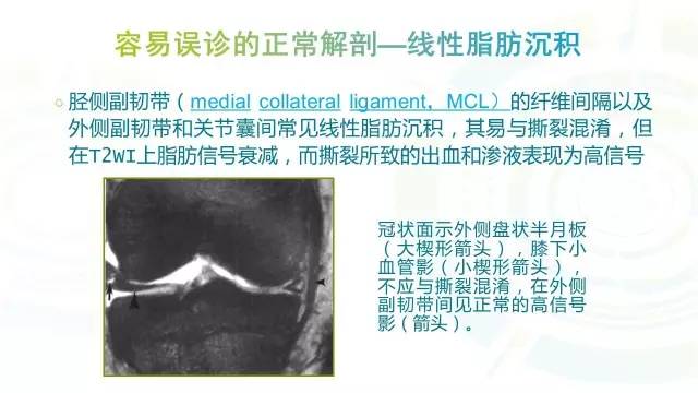 【PPT】膝关节周围韧带解剖及MR表现