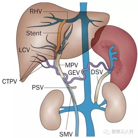 “门静脉海绵样变”的影像诊断 “门静脉海绵样变”的影像诊断