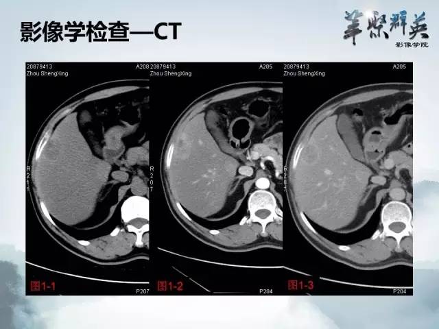 【病例】肝胆管腺瘤1例CT及MR影像表现